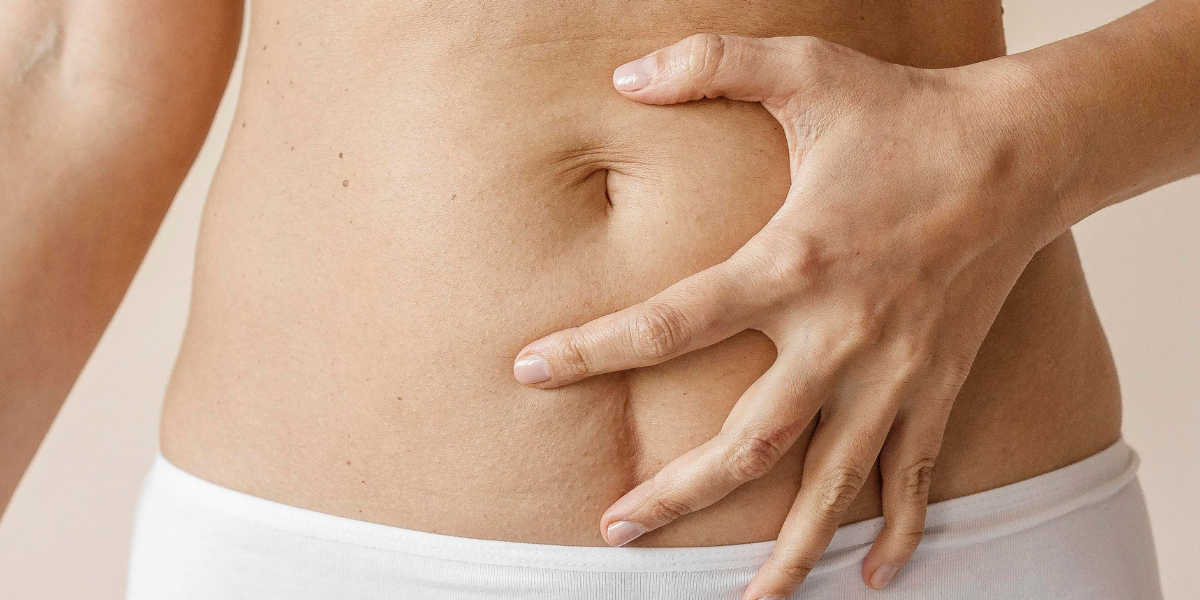 Can Collagen Help with Stretch Marks